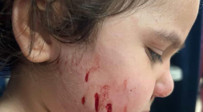 İZMİR çiğlide çocuğa köpek saldırdı