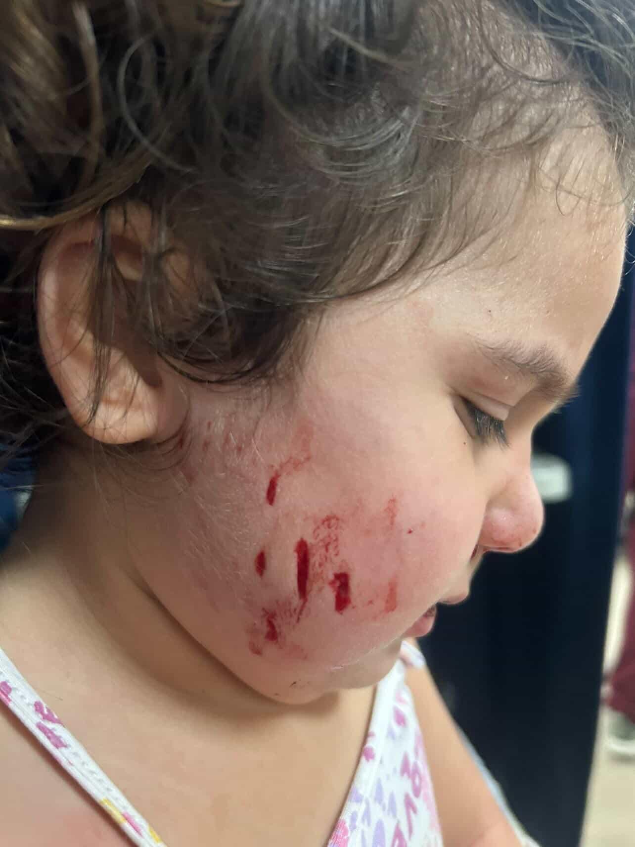 İZMİR çiğlide çocuğa köpek saldırdı